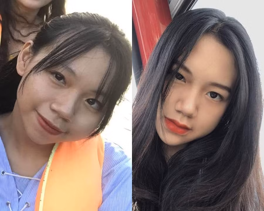 Bị bạn học trêu chọc là xấu xí, cô gái đợi đến 19 tuổi để phẫu thuật thẩm mỹ thành hot girl-4