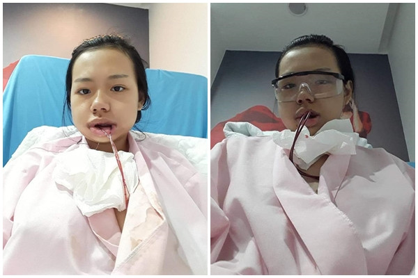 Bị bạn học trêu chọc là xấu xí, cô gái đợi đến 19 tuổi để phẫu thuật thẩm mỹ thành hot girl-2