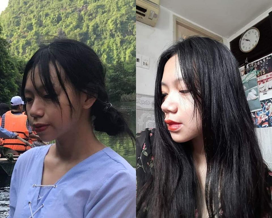 Bị bạn học trêu chọc là xấu xí, cô gái đợi đến 19 tuổi để phẫu thuật thẩm mỹ thành hot girl-6