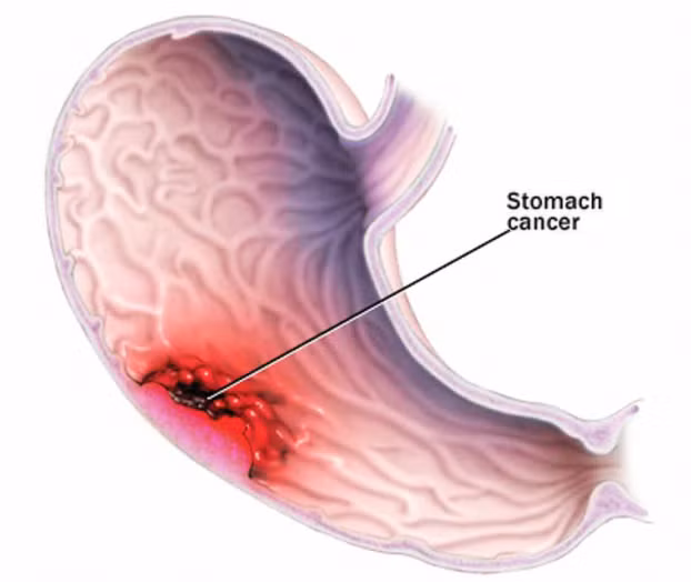  Hình ảnh mô tả tế bào ung thư phát triển trong dạ dày. 