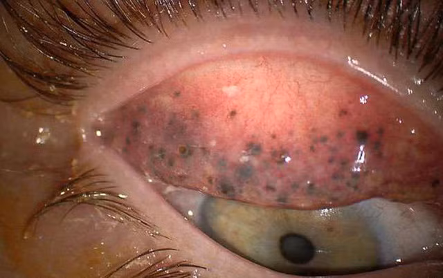 Nếu để lâu, mắt Theresa có thể bị nhiễm trùng và mù vĩnh viễn