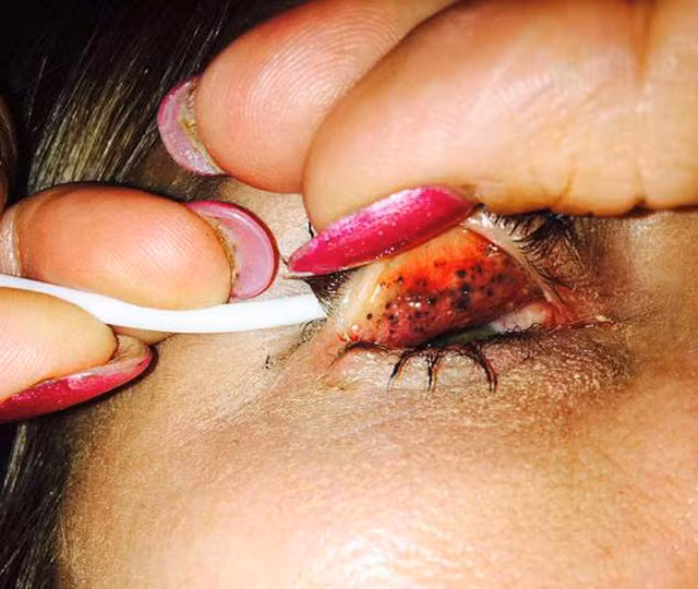 Khi mới nhập viện, tình trạng mắt của cô vô cùng đáng sợ và vẫn còn nguyên mascara trên lông mi