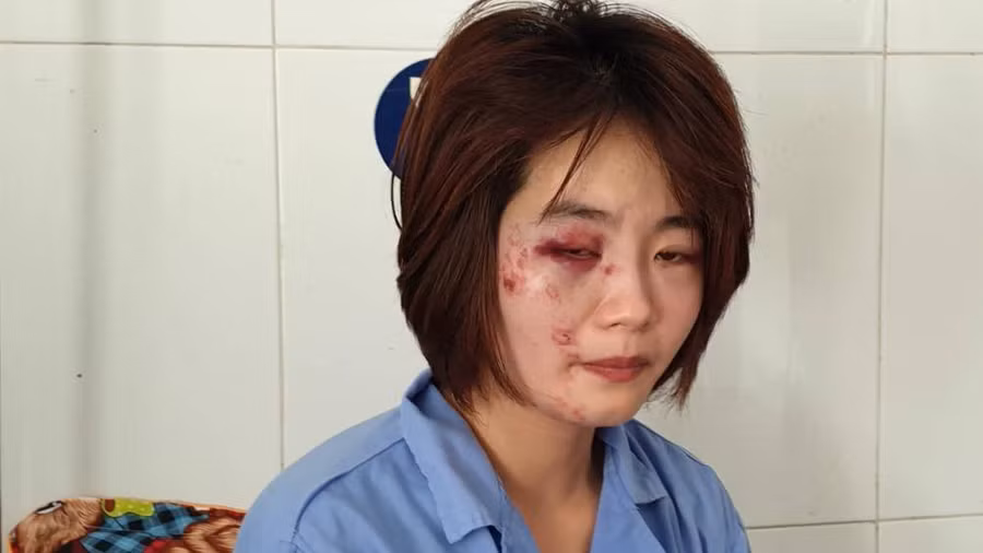 Nữ nhân viên phục vụ xe buýt Đỗ Thuý Hinh điều trị tại bệnh viên đa khoa Ứng Hoà, Hà Nội.