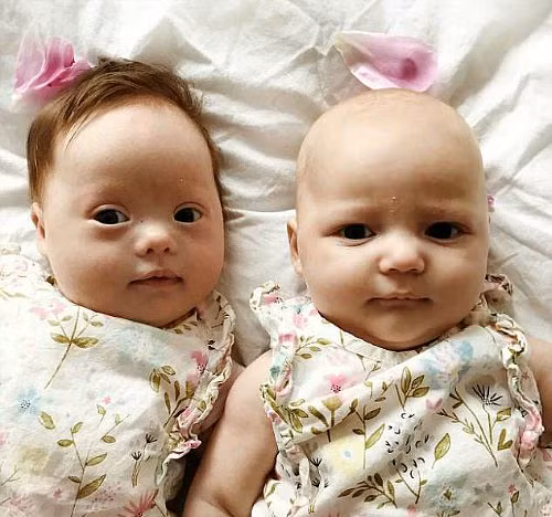 Cặp song sinh ‘triệu đôi có một’ - Hình 1