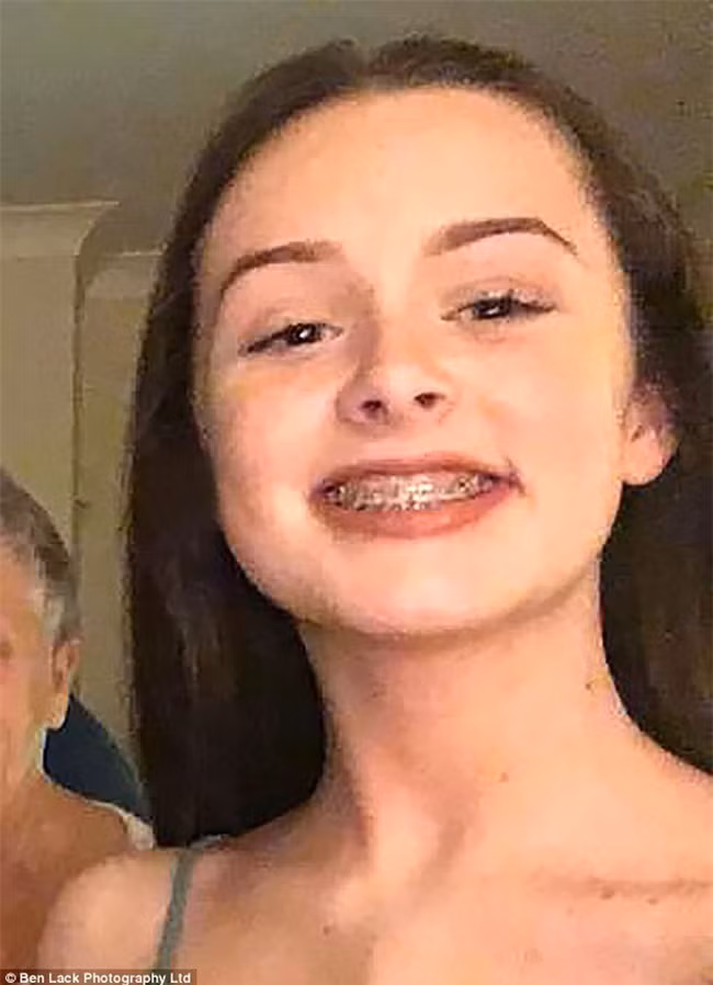 Cô gái 15 tuổi suýt chết vì bệnh nhiễm khuẩn, nguyên nhân được chẩn đoán là từ... niềng răng - Ảnh 1.