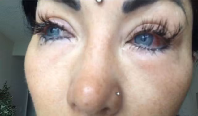 Mắt cô bị viêm đau, đỏ quạnh đáng sợ