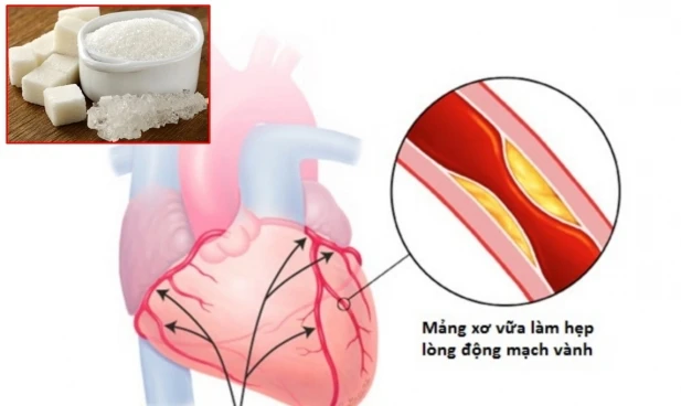 Người bị bệnh động mạch vành có nên ăn đường không?