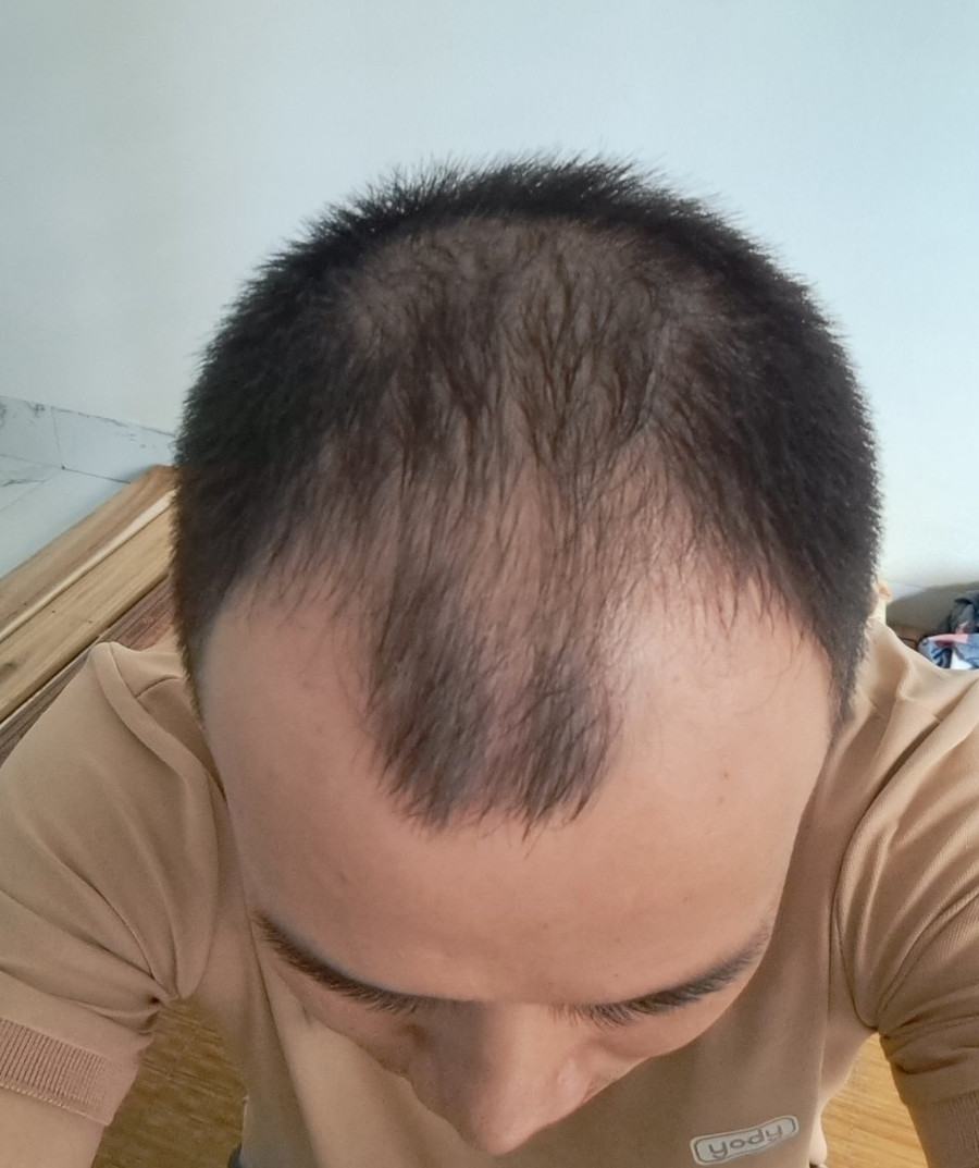 Anh T. bị rụng tóc nhiều hơn sau khi tới Mayo Clinic Thanh Hoá trị hói đầu. (Ảnh: NVCC). Anh T. bị rụng tóc nhiều hơn sau khi tới Mayo Clinic Thanh Hoá trị hói đầu. (Ảnh: NVCC).