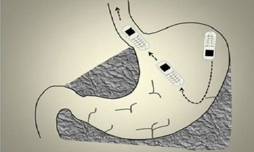 phau-thuat-lay-dien-thoai-nho-nhat-the-gioi-bi-nuot-vao-bung