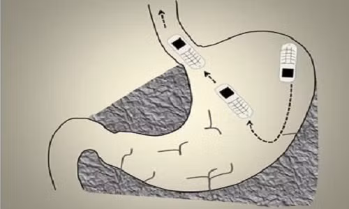 phau-thuat-lay-dien-thoai-nho-nhat-the-gioi-bi-nuot-vao-bung