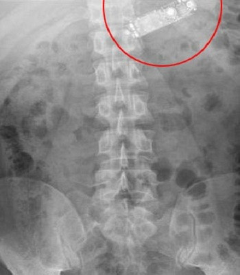 phau-thuat-lay-dien-thoai-nho-nhat-the-gioi-bi-nuot-vao-bung-1