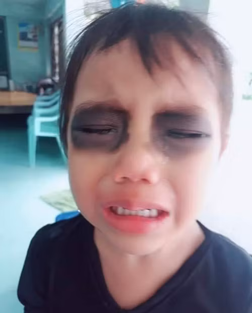 Cô bé òa khóc khi thấy mắt mình thâm đen.