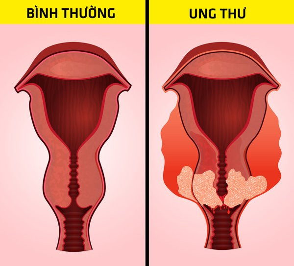 Bụng đầy hơi có thể cảnh báo 6 bệnh nguy hiểm chết người ảnh 5 bung day hoi ai cung gap nhung can than no co the canh bao 6 benh nguy hiem chet nguoi - 6