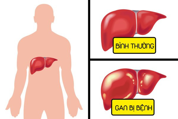 Bụng đầy hơi có thể cảnh báo 6 bệnh nguy hiểm chết người ảnh 2 bung day hoi ai cung gap nhung can than no co the canh bao 6 benh nguy hiem chet nguoi - 3