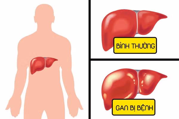 bung day hoi ai cung gap nhung can than no co the canh bao 6 benh nguy hiem chet nguoi - 3