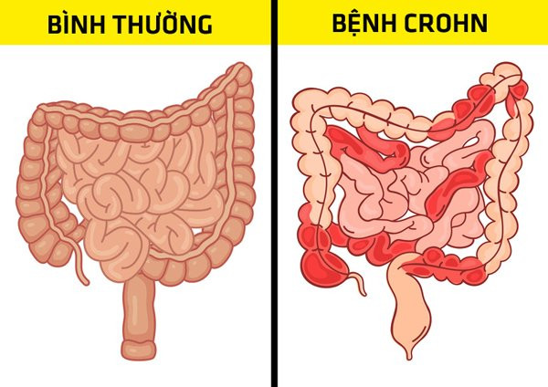 Bụng đầy hơi có thể cảnh báo 6 bệnh nguy hiểm chết người ảnh 3 bung day hoi ai cung gap nhung can than no co the canh bao 6 benh nguy hiem chet nguoi - 4