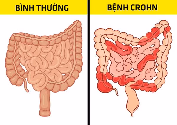 bung day hoi ai cung gap nhung can than no co the canh bao 6 benh nguy hiem chet nguoi - 4