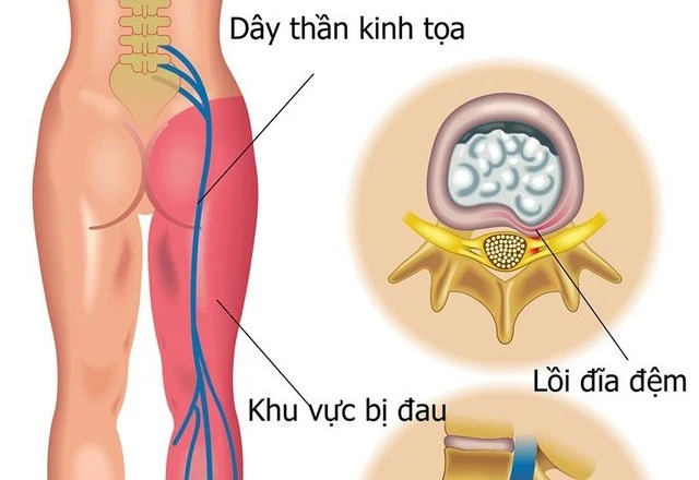 Khi nào tê nhức chân tay là bệnh lý?