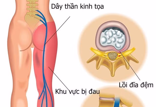 Khi nào tê nhức chân tay là bệnh lý?