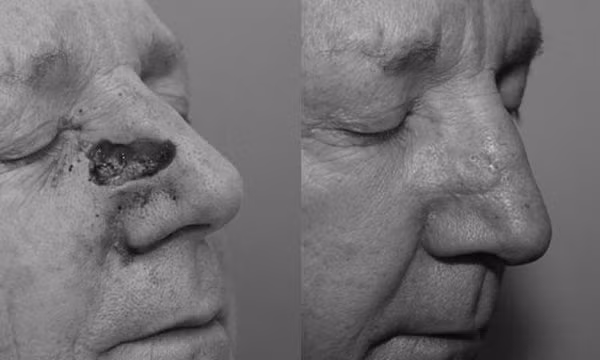 Ngôi sao cầu lông thế giới 36 tuổi mắc ung thư mũi