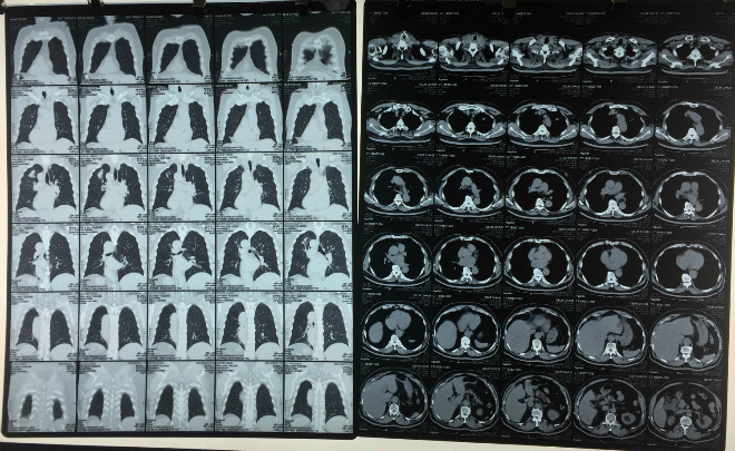 Khối u phổi trên phim CT của bệnh nhân. Khối u phổi trên phim CT của bệnh nhân.