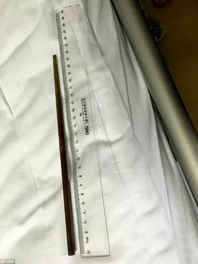 Vẫn sống sót dù nuốt đũa vào bụng suốt ba tháng ảnh 1 Cây đũa dài 24cm nằm trong bụng suốt 3 tháng.