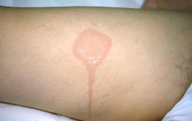 Những căn bệnh quái đản chỉ cần nghe tên đã thấy rùng mình - Ảnh 7.