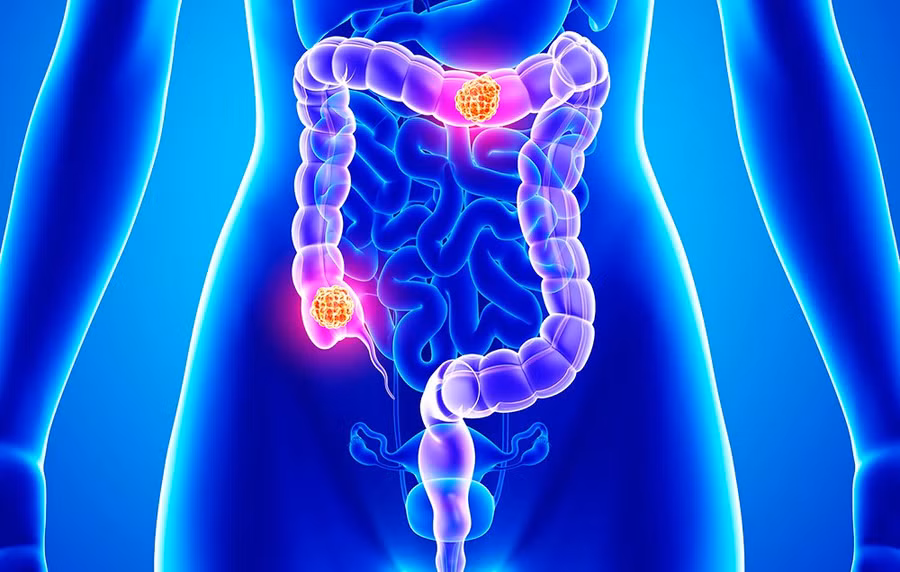 9X có triệu chứng này cần nghĩ ngay đến ung thư