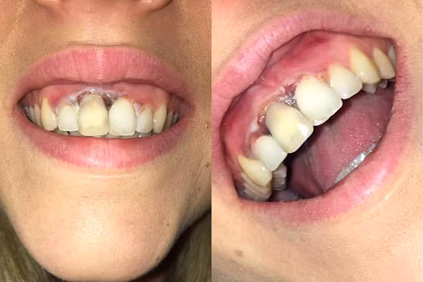 Phần lợi xung quanh 4 răng cửa của Wills chuyển sang màu đen và đau đớn sau khi tẩy trắng răng.