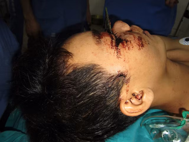 Lưỡi cưa cắm thẳng vào vùng giữa hai mắt bệnh nhân, nhô lên 5- 7 cm khi được đưa tới viện. Ảnh: BS cung cấp,