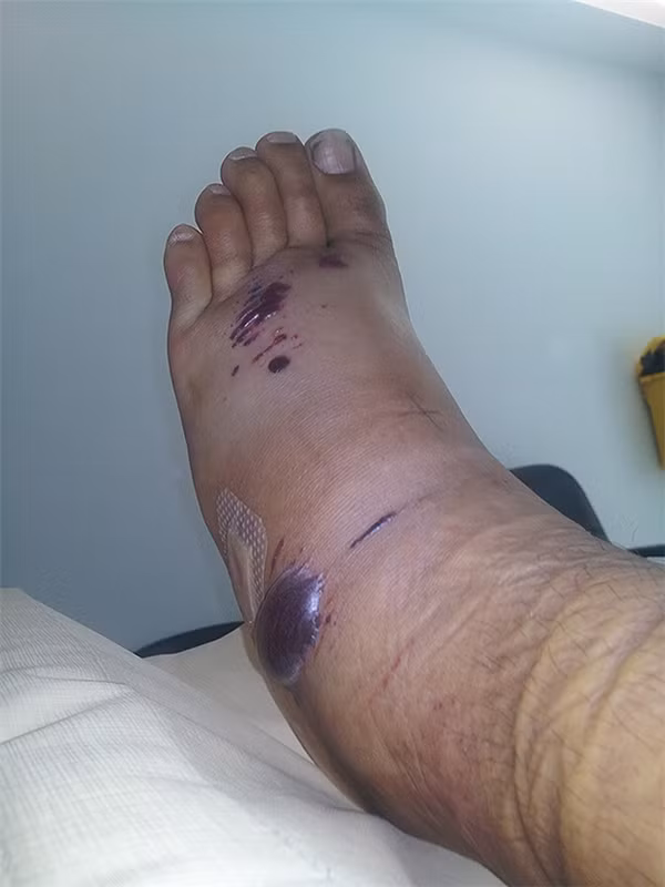 Nếu đi biển mà dẫm phải cá mặt quỷ thì chân bạn sẽ trông giống thế này.