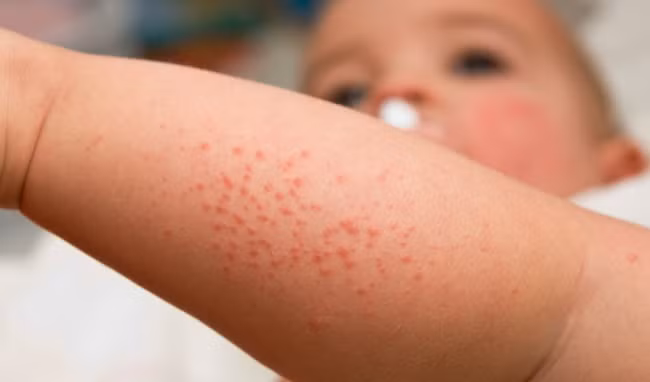 10-cach-khac-phuc-benh-eczema-o-tre-em11535173357