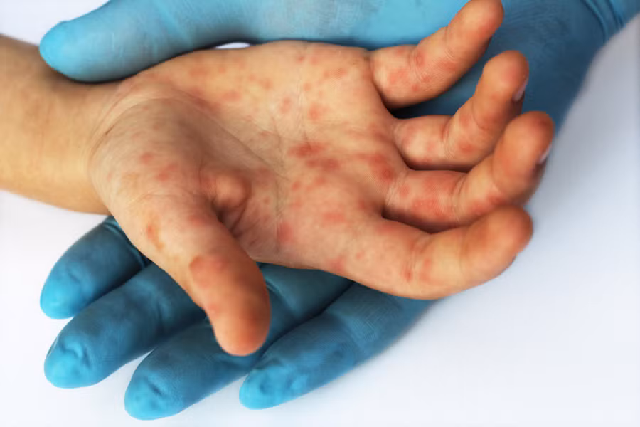 Virus bệnh sởi phổ biến hơn ở trẻ nhỏ chưa có khả năng miễn dịch so với người lớn. (Ảnh: ITN)