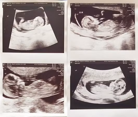 Ảnh siêu âm của 4 người con
