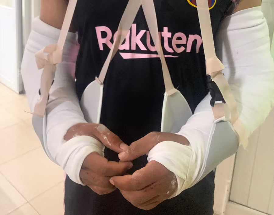 Anh Đạt bị gãy hai cánh tay với tổng 5 vị trí bị gãy, hiện anh đang điều trị tại Bệnh viện Quân y C17 (Đà Nẵng) và phải mổ sắp lại xương bị gãy.