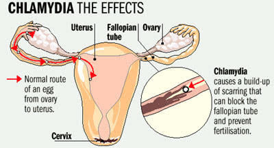 Vi khuẩn âm đạo gắn với nguy cơ cao mắc bệnh Chlamydia