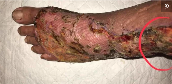 Vi khuẩn ăn thịt người gần như đã lấy mất chân người đàn ông này, những ai đi biển cần chú ý! - Ảnh 1. Vi khuẩn ăn thịt người gần như đã lấy mất chân người đàn ông này, những ai đi biển cần chú ý! - Ảnh 1.