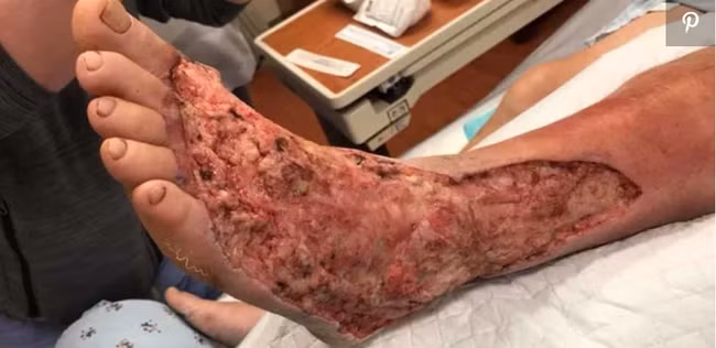 Người đàn ông đang mất dần đôi chân do vi khuẩn ăn thịt người