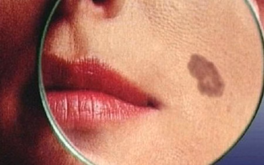 Căn bệnh ung thư từ nốt ruồi, di căn cực nhanh: Dấu hiệu khác biệt cần khám ngay-2