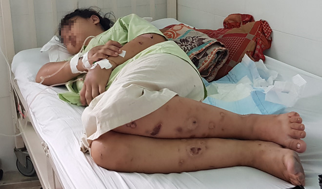 Nạn nhân H.N.Y (18 tuổi) lúc nằm điều trị tại bệnh viện /// Ảnh: Duy Tính