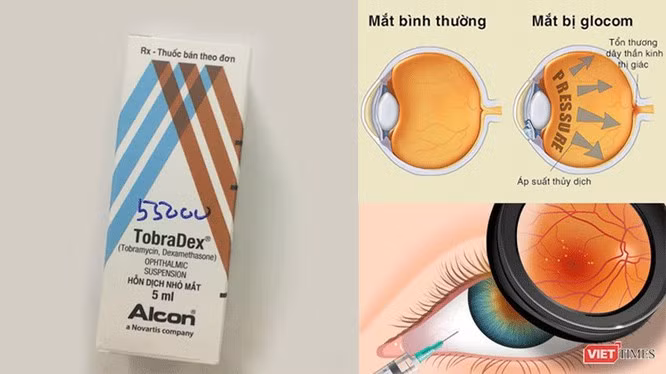 Tự ý sử dụng thuốc Tobradex, đôi mắt có thể bị tổn thương nặng, thậm chí mù lòa.