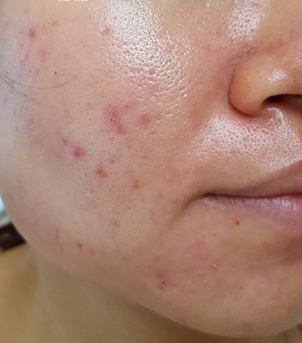 Mẹ 2 con mặt nổi đầy mụn bỗng sáng mịn không tỳ vết sau 3 tháng uống thứ này ảnh 1 Empty