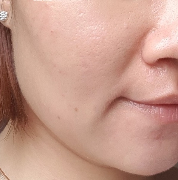 Mẹ 2 con mặt nổi đầy mụn bỗng sáng mịn không tỳ vết sau 3 tháng uống thứ này ảnh 3 Empty