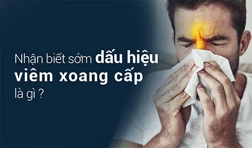 Viêm xoang cấp cần được nhận biết sớm và điều trị ngay.