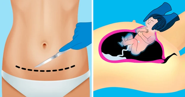Mách mẹ 5 cách giúp vết mổ đẻ không đau, nhanh lành, không để lại sẹo