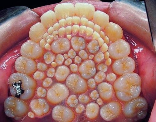 Cậu bé mọc gần 300 chiếc răng trong miệng