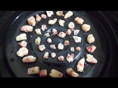 Sốc: Bé trai 9 tuổi mọc gần 300 chiếc răng trong miệng hình ảnh 3 soc: be trai 9 tuoi moc gan 300 chiec rang trong mieng hinh anh 3
