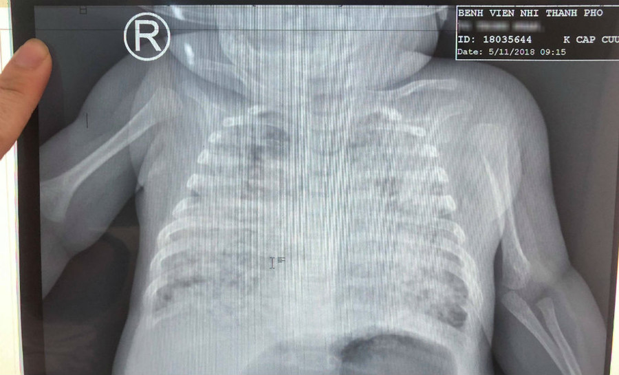 90 ngày chống chọi tử thần của bé 2 tháng bị lây bệnh từ bố