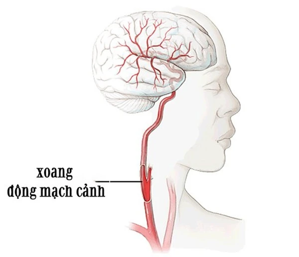 Vị trí xoang động mạch cảnh, nằm ở 2 bên cổ.