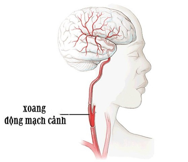 Vị trí xoang động mạch cảnh, nằm ở 2 bên cổ.